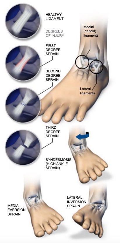 anatomy of a sprain